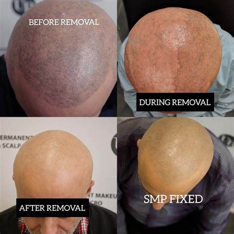 scalp micropigmentation regrets